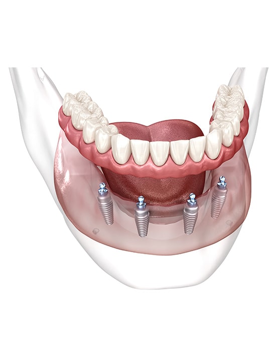 Implants
